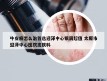 牛皮癣怎么治首选迎泽中心银屑超值 太原市迎泽中心医院皮肤科