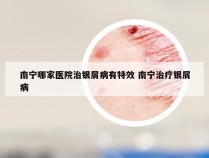 南宁哪家医院治银屑病有特效 南宁治疗银屑病