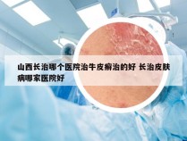 山西长治哪个医院治牛皮癣治的好 长治皮肤病哪家医院好