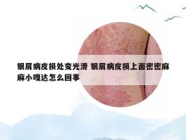 银屑病皮损处变光滑 银屑病皮损上面密密麻麻小嘎达怎么回事