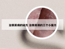 治银屑病的秘方 治银屑病的三个小偏方