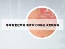 牛皮癣查过敏源 牛皮癣化验血可以查出来吗