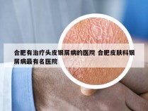 合肥有治疗头皮银屑病的医院 合肥皮肤科银屑病最有名医院