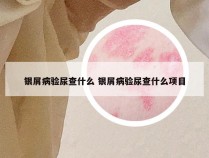 银屑病验尿查什么 银屑病验尿查什么项目