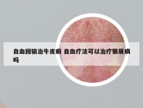 自血回输治牛皮癣 自血疗法可以治疗银屑病吗