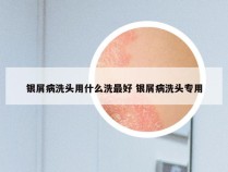 银屑病洗头用什么洗最好 银屑病洗头专用