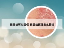 银屑病可以医保 银屑病医保怎么报销