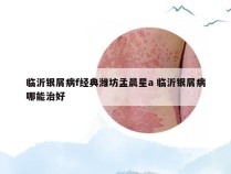 临沂银屑病f经典潍坊孟晨星a 临沂银屑病哪能治好