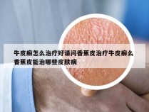 牛皮癣怎么治疗好请问香蕉皮治疗牛皮癣么 香蕉皮能治哪些皮肤病
