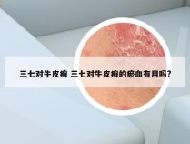 三七对牛皮癣 三七对牛皮癣的瘀血有用吗?