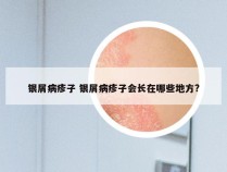 银屑病疹子 银屑病疹子会长在哪些地方?