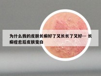 为什么我的皮肤长癣好了又长长了又好… 长癣痊愈后皮肤变白