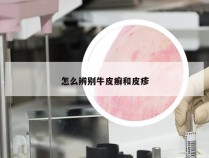 怎么辨别牛皮癣和皮疹