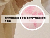 南京皮肤科医院牛皮癣 南京市牛皮癣医院哪个有名