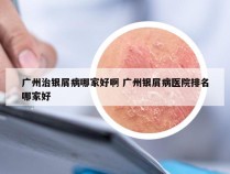 广州治银屑病哪家好啊 广州银屑病医院排名哪家好