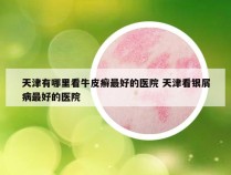 天津有哪里看牛皮癣最好的医院 天津看银屑病最好的医院