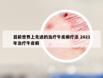 目前世界上先进的治疗牛皮癣疗法 2021年治疗牛皮癣