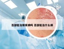 百部能治银屑病吗 百部能治什么病