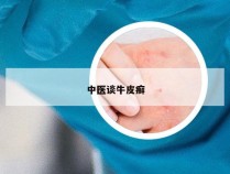 中医谈牛皮癣