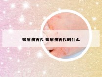 银屑病古代 银屑病古代叫什么