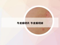 牛皮癣切片 牛皮癣切掉