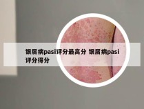 银屑病pasi评分最高分 银屑病pasi评分得分