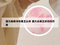 强力癣痒净效果怎么样 强力去癣王的功效作用
