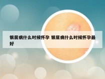 银屑病什么时候怀孕 银屑病什么时候怀孕最好