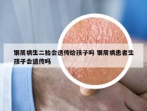 银屑病生二胎会遗传给孩子吗 银屑病患者生孩子会遗传吗