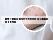 昆明好的银屑病医院有哪些医院 昆明看银屑哪个医院好
