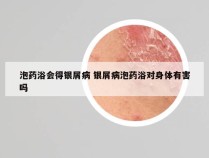 泡药浴会得银屑病 银屑病泡药浴对身体有害吗