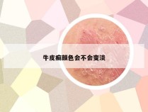 牛皮癣颜色会不会变淡