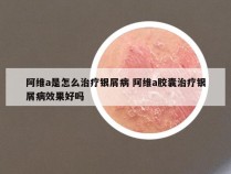 阿维a是怎么治疗银屑病 阿维a胶囊治疗银屑病效果好吗