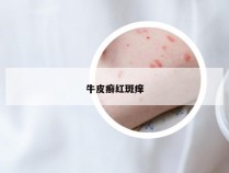 牛皮癣红斑痒