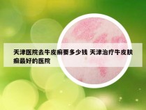 天津医院去牛皮癣要多少钱 天津治疗牛皮肤癣最好的医院