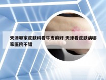 天津哪家皮肤科看牛皮癣好 天津看皮肤病哪家医院不错