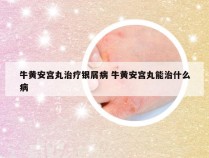 牛黄安宫丸治疗银屑病 牛黄安宫丸能治什么病