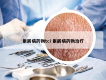 银屑病药物tci 银屑病药物治疗