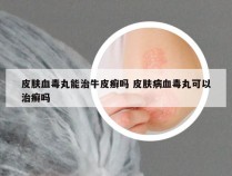 皮肤血毒丸能治牛皮癣吗 皮肤病血毒丸可以治癣吗