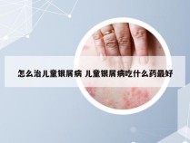 怎么治儿童银屑病 儿童银屑病吃什么药最好