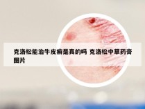 克洛松能治牛皮癣是真的吗 克洛松中草药膏图片