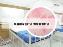 银屑病深色红点 银屑病有红点