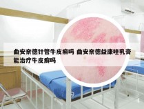 曲安奈德针管牛皮癣吗 曲安奈德益康唑乳膏能治疗牛皮癣吗