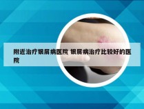 附近治疗银屑病医院 银屑病治疗比较好的医院