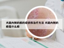 大腿内侧的癣的症状和治疗方法 大腿内侧的癣是什么癣