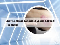 成都什么医院看牛皮癣最好 成都什么医院看牛皮癣最好