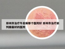 郑州市治疗牛皮癣那个医院好 郑州市治疗前列腺最好的医院