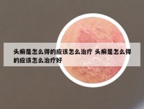 头癣是怎么得的应该怎么治疗 头癣是怎么得的应该怎么治疗好