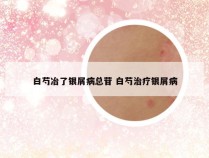 白芍冶了银屑病总苷 白芍治疗银屑病