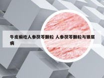 牛皮癣吃人参茯苓颗粒 人参茯苓颗粒与银屑病